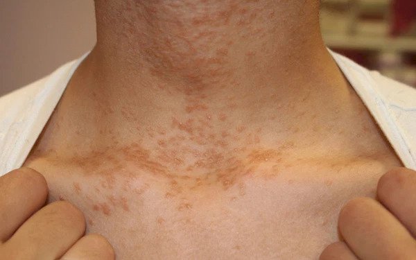 3 thay đổi trên cổ có thể là dấu hiệu sớm của bệnh ung thư mà bạn không nên chủ quan bỏ qua