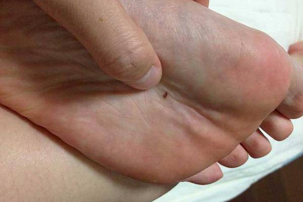 2 hiện tượng bất thường xuất hiện ở lòng bàn tay, lòng bàn chân cảnh báo tế bào ung thư đang nhen nhóm phát triển