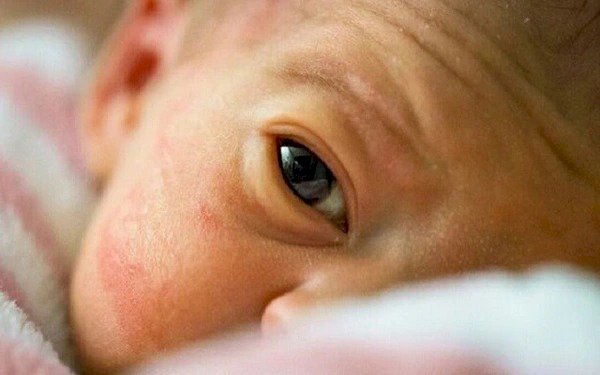 Mỹ và Indonesia xác nhận thêm ca tử vong do viêm gan bí ẩn dù bệnh nhi không có bệnh nền, không có virus: Cảnh báo 5 TRIỆU CHỨNG ở trẻ cha mẹ cần đặc biệt theo dõi