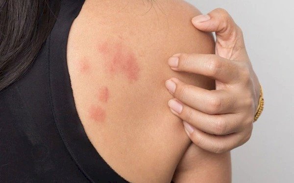  Nghiên cứu mới: Chất xơ trong ruột có thể giúp ích cho các bệnh về dị ứng da