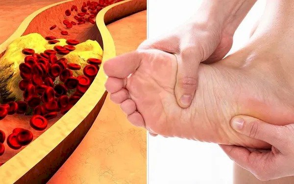  Gầy như 'xác ve' vẫn mỡ máu cao: Thấy đau ở bộ phận này thì đừng làm ngơ