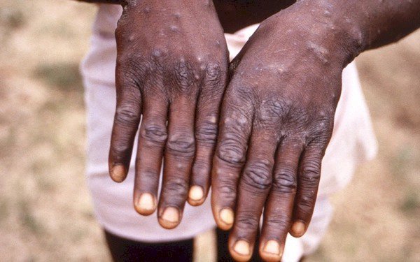  Bộ Y tế hướng dẫn điều trị bệnh đậu mùa khỉ