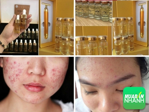 Da mụn có nên dùng serum không