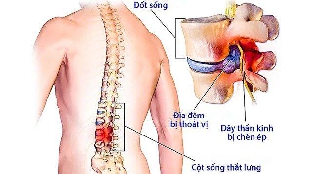 Ngồi 8 tiếng một ngày, dân công sở than trời vì đau lưng: CẢNH BÁO căn bệnh khiến cột sống có nguy cơ bị LIỆT TÀN PHẾ hoặc TEO CƠ CHI suốt đời